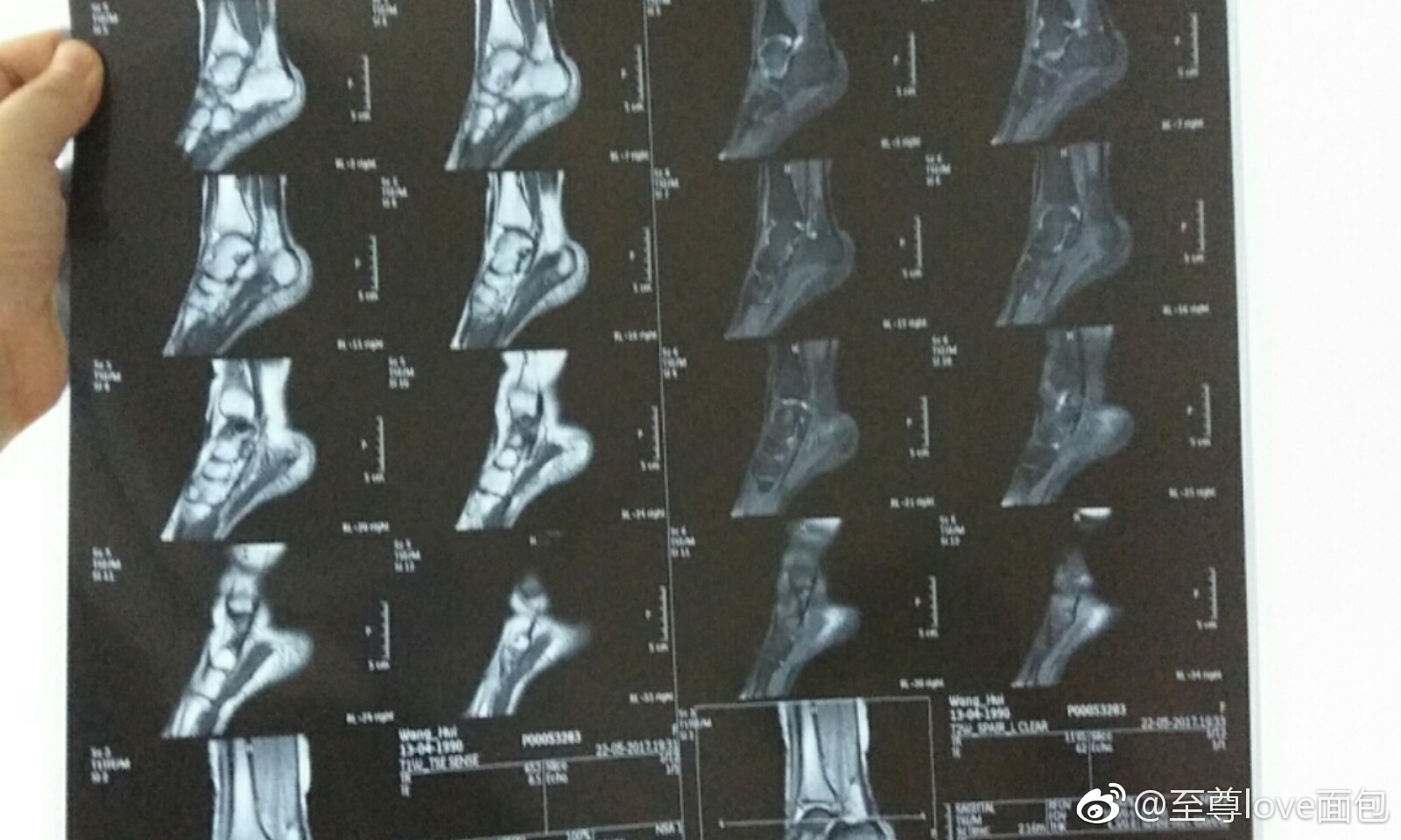 供卵试管婴儿雌激素的补充-供卵试管婴儿雌激素的补充