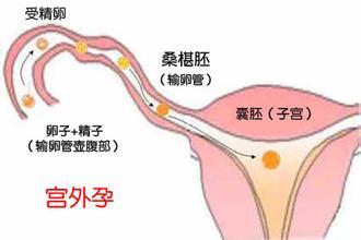 接受供卵试管婴儿的注意事项