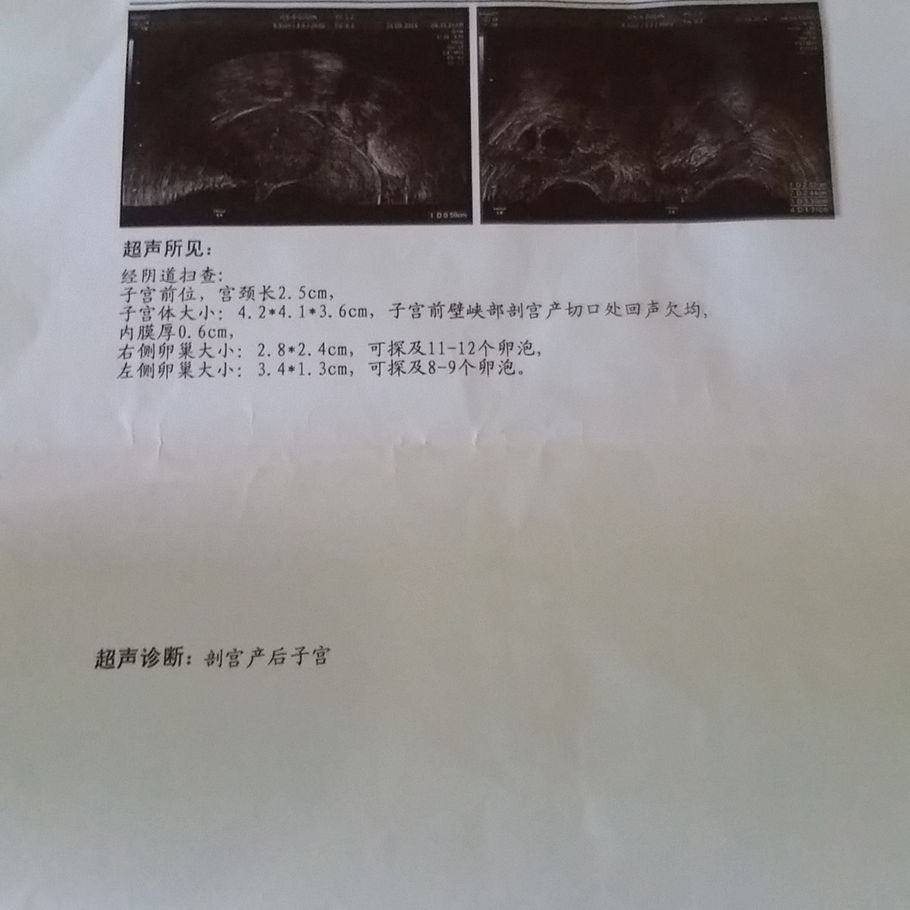 借卵做试管婴儿疼吗多少钱