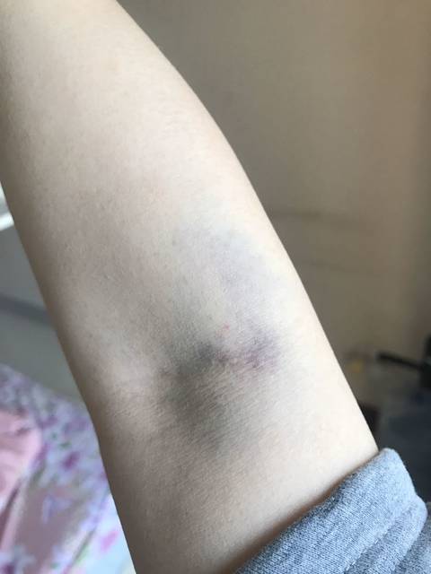 试管需要打什么针
